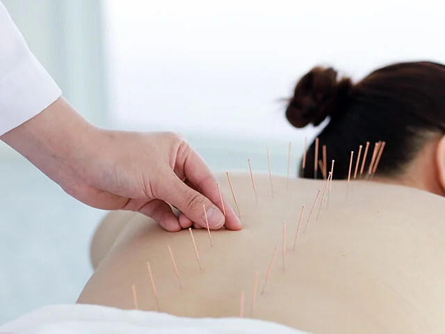 Benefícios da Acupuntura